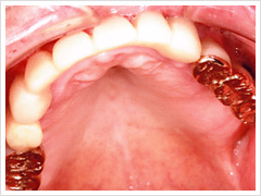 インプラント症例
