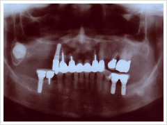 入れ歯症例